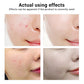 Acne Treatment Face Serum Mask Pimple Scar Remover Moisturizing