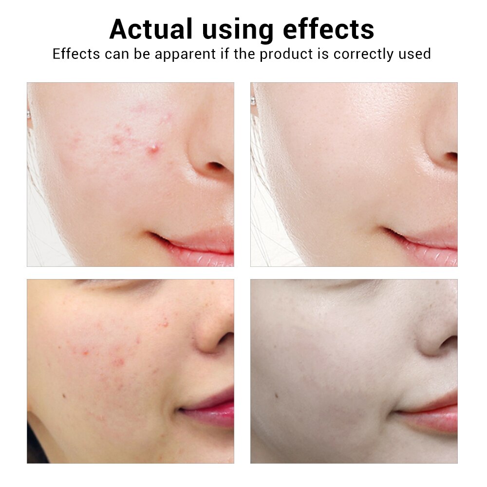 Acne Treatment Face Serum Mask Pimple Scar Remover Moisturizing
