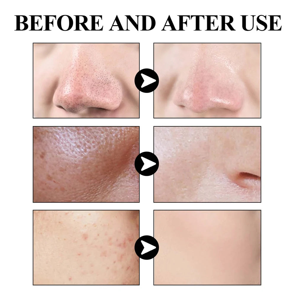 West Month Blackhead Mud Mask Oil Control Pore Shrinking